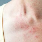 Allerjik deri döküntüleri