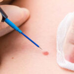 Siğil (HPV) tedavisi