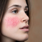 Akne rozasea (Gül hastalığı)