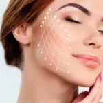 Ameliyatsız yüz germe (Forma)