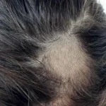 Alopesi areata (Saç kıran)