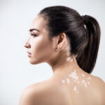 Vitiligo